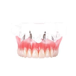 Dentalmall Dental Upper Implants Model Overdenture with 4 Superior Teeth Demo Transparent Vision for Education and Study Model Tool M6001 C