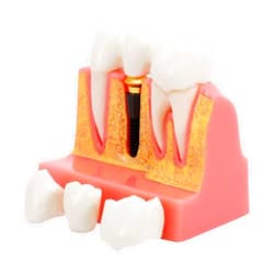 Annhua 4 Times Dental Implant Teeth Model Analysis Crown Bridge Demonstration Model, Dental Teeth Crown Roots Removable for Education, Patients Communication, Learning and Lab