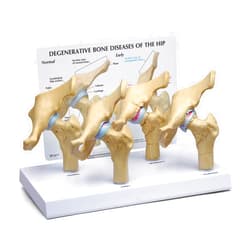 GPI Anatomicals - 4-Stage Diseased Hip Joint Model Set, Degenerative Bone Disease Model for Anatomy, Physiology Education, Anatomy Model for Doctor's Offices and Classrooms, Medical Learning Resources