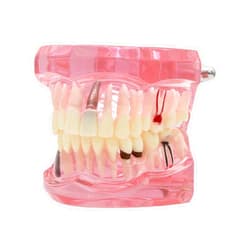 Dentalmall Teeth Model Teeth Typodonts Dental Implant Study Analysis Demonstration Teeth Model #2001 with Restoration Pink