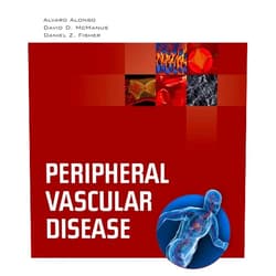 By Alvaro Alonso (Author), Daniel D. McManus (Author), Daniel Z. Fisher (Author) & 0 more Peripheral Vascular Disease: .