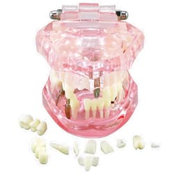 NC Dental Typodont Model Implant Restoration Tooth Model Disease Pathology Analysis Teeth Bridge Crown Teach Study Tooth Education