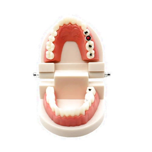 RUCYAI Dentist Caries Model for Teaching Decay Tooth Model Teeth Care Dental StudyModel