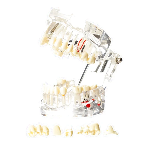 Dentalmall Dental Oral Typodont Model Implant Pathological Removable Teach Demo Visible Anatomy Demonstration Teaching Standard Size (Clear)