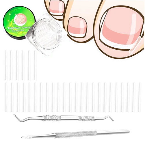 Emsiok (30+2) Pack Ingrown Toenail Correction Treatment Kit, 30PCS Ingrown Toenail Corrector Strips Brace Ingrown Toenail Pedicure Tool Toenail Correction Patch with 2PCS Ingrown Toenail Lifter and File