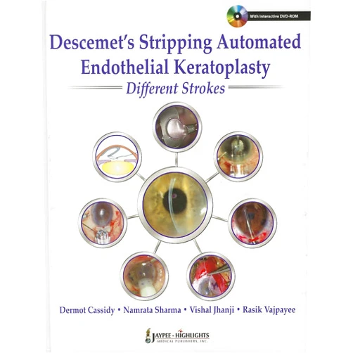 By Dermot Cassidy (Author), Namrata Sharma (Author), M.D. Jhanji, Vishal (Author), Rasik B. Vajpayee (Author) & 1 more Descemet's Stripping Automated Endothelial Keratoplasty Different Strokes