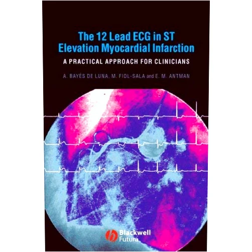 By Antonio Bayés de Luna (Author), Miquel Fiol-Sala MD (Author), Elliot M. Antman MD (Author) & 0 more Format: Kindle Edition The 12 Lead ECG in ST Elevation Myocardial Infarction: A Practical Approach for Clinicians