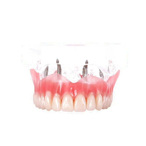 Dentalmall Dental Upper Implants Model Overdenture with 4 Superior Teeth Demo Transparent Vision for Education and Study Model Tool M6001 C