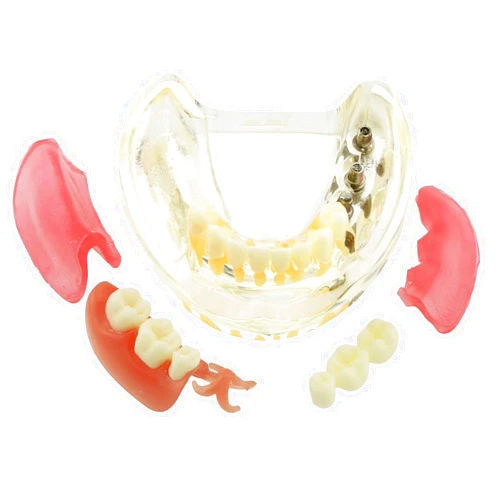 DEBKSGEOTI Dental Implant Typodont Restoration Teeth Model M6006 Overdenture 3 Implants Bridge Inferior Lower Treatment Demo for Study Teach