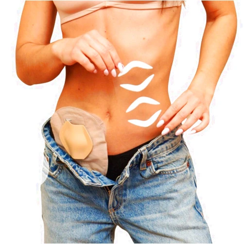SIIL Stoma Guard Shield for Ostomy bags. Protect your Colostomy Bags & Ileostomy supplies with Stoma Protector | Stoma Cover