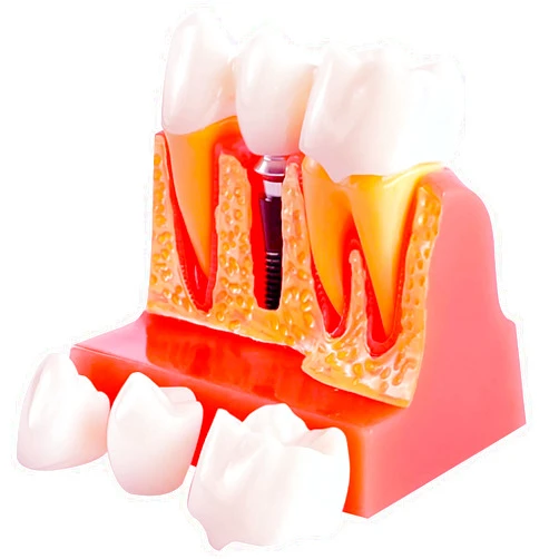 Ceonam Dental Implant Model with Removable Crown Bridge - 4 Times Enlarged Demonstrative Teeth Model for Education and Study - Ideal for Class Demonstrations and Dental Student Training