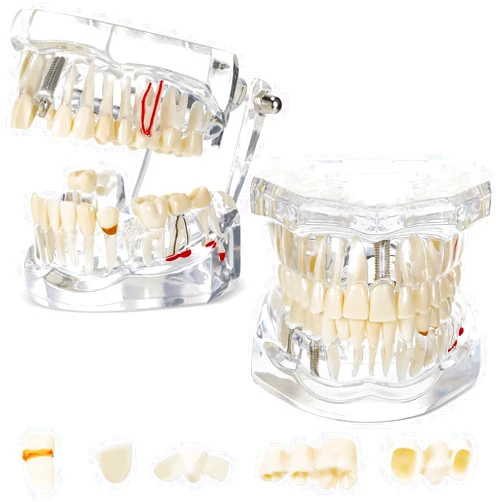 Outus Disease Teeth Model Dental Typodonts Implant Teeth Model with Removable Teeth Dentist Standard Tooth Pathological Demonstration for Christmas Education Dental Supplies (Transparent,2 Pcs)