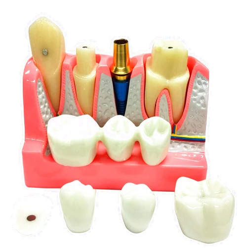 RWBATT 4 Times Dental Implant Model with Removable Crown Bridge Dental Veneers Porcelain Teeth for Stutent Study and Teaching Demonstration