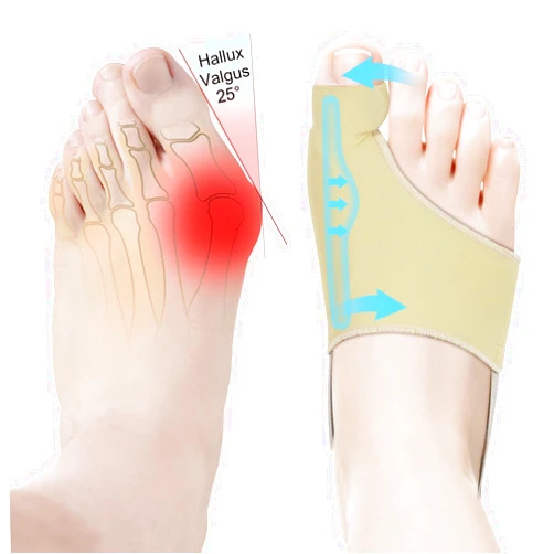 HLOES 2Pcs Bunion Corrector for Women Big Toe Straightener-Bunion Splint-Bunion Pads for Bunion Relief-Hallux Valgus Pain Relief,Comfortable & Breathable for Day/Night