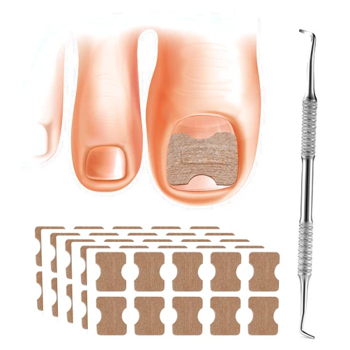 FERYES 50 PCS Breathable Ingrown Toenail Corrector Patch with Double-Ended Stainless Steel Toenail Lifter – Comprehensive Toenail Care Solution