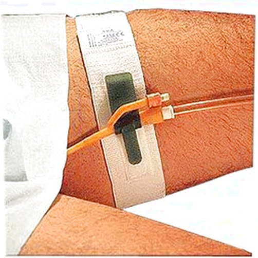 Dale Medical Products Inc DA316EA - Hold-n-Place Foley Catheter Holder Leg Band, Up to 20