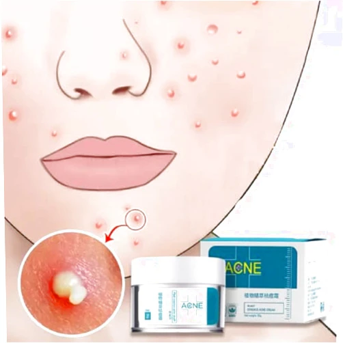 NAMINA Crema Para El Acne ELIMINA Barros Espinillas Y Manchas RECUPERA Tu Piel LINDA
