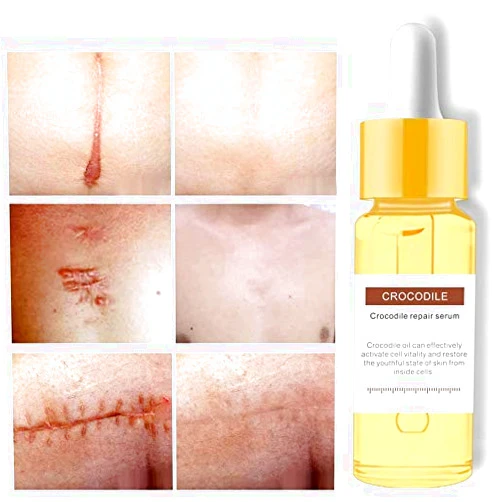 HHQueen 15g Scar Removal, Scar Repair Oil, Removal Scars Marks Treatment, Scar Essence, Skin Repair Oil, Stretch Mark Repair Cream