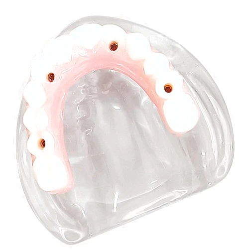 KH66ZKY Dental Implant Model with Bridge Prosthesis Adult Teeth Study Dental Pathological Disease Implant Teaching Typodont Model for Dental Studies & Research