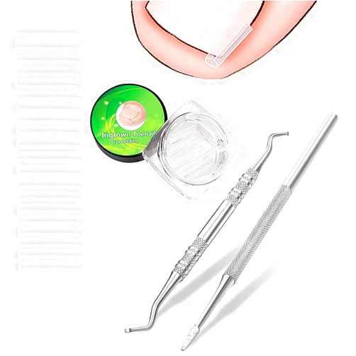 ZDU (50 +2) Pack Professional Ingrown Toenail Correction Treatment Kit, 50 Pcs Ingrown Toenail Corrector Straightener Strips Recover Clips with 2 Pcs Ingrown Toenail File And Lifter