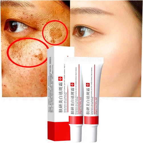 Fupah 2 Pcs Whitening Freckle Cream, Acne Scar Removal Treatment Cream, Pigmentation Removal Cream for Face, Moisturizing Removes Facial Melasma Dark Spots Wrinkles Blemishes (whitening freckle cream)