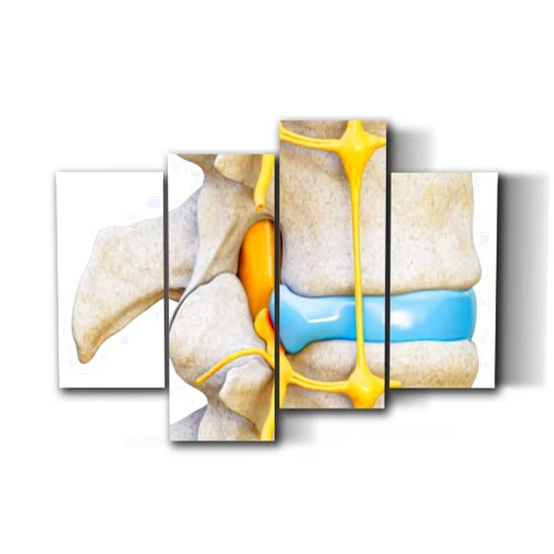 UJOYAFZSIM Orthopedic Human Anatomy Medical Poster Herniated spinal nerve compression 3D lateral Wall Art Decor for Doctor Office Clinic Gift for Nurse Physicians Assistant Physical Therapist