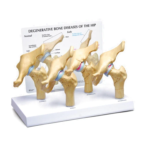 GPI Anatomicals - 4-Stage Diseased Hip Joint Model Set, Degenerative Bone Disease Model for Anatomy, Physiology Education, Anatomy Model for Doctor's Offices and Classrooms, Medical Learning Resources
