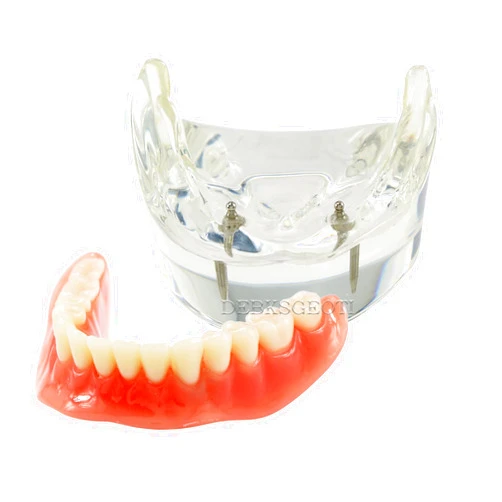 DEBKSGEOTI Dental Teeth Model Typodont Implant Restoration M6002 Overdenture 2 Implants Lower Inferior Demo for Study Teach