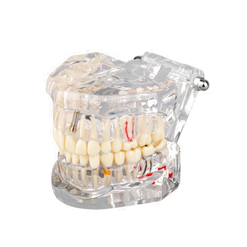 Ultrassist Transparent Disease Teeth Model with Dental Implant Bridge, Dental Model for Patient and Dental Student Education