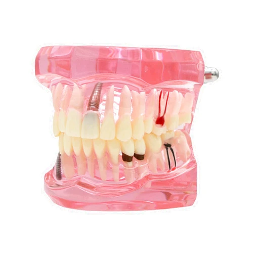 Dentalmall Teeth Model Teeth Typodonts Dental Implant Study Analysis Demonstration Teeth Model #2001 with Restoration Pink