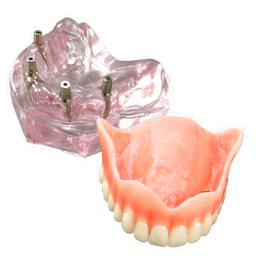 Smile1000 Dental Model Overdenture Upper Teeth 4 Implants Demo for Teaching and Studying