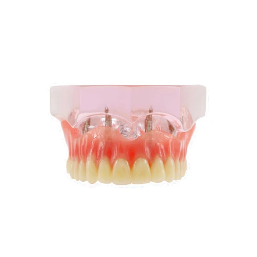 Sprucedent Dental Implant Teeth Demo Model Maxillary Overdenture with 4 Implants